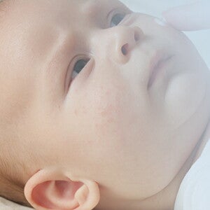 Fragen und Antworten zu Allergien bei kleinen Babys. Fragen und Antworten zu Allergien bei kleinen Babys.